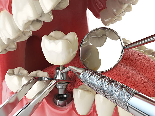 Best Emergency Dental Care for Broken or Chipped Teeth in West Baraboo, WI